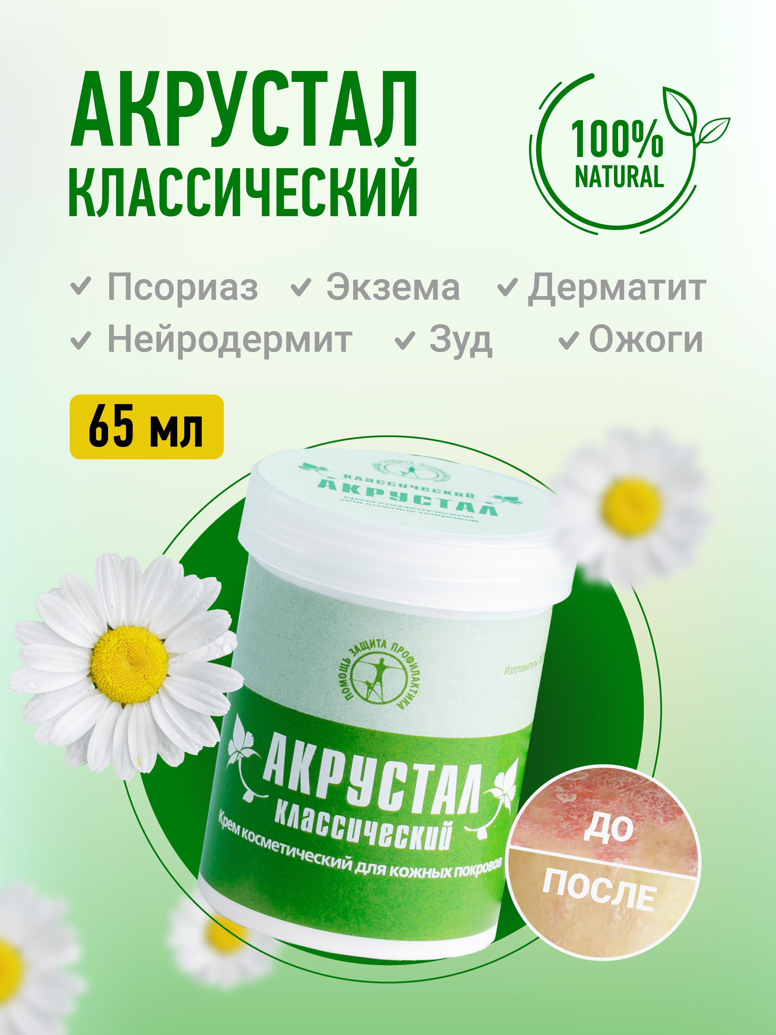 Акрустал Мазь От Псориаза Отзывы Цена