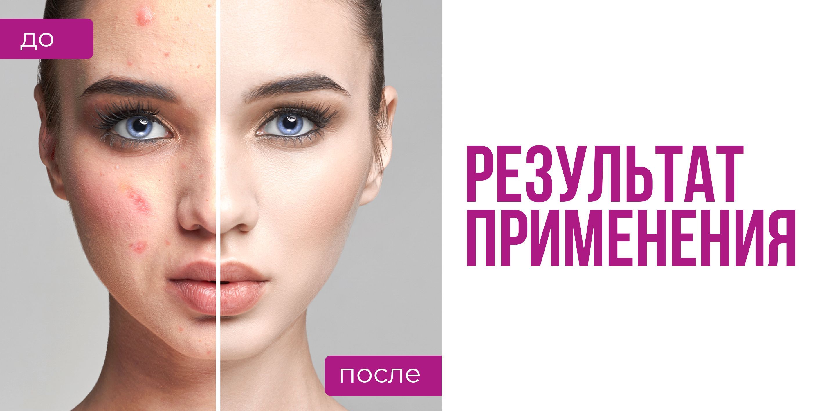 XFML balace / Фуманлинг от акне, крем от прыщей, от подкожного клеща ...