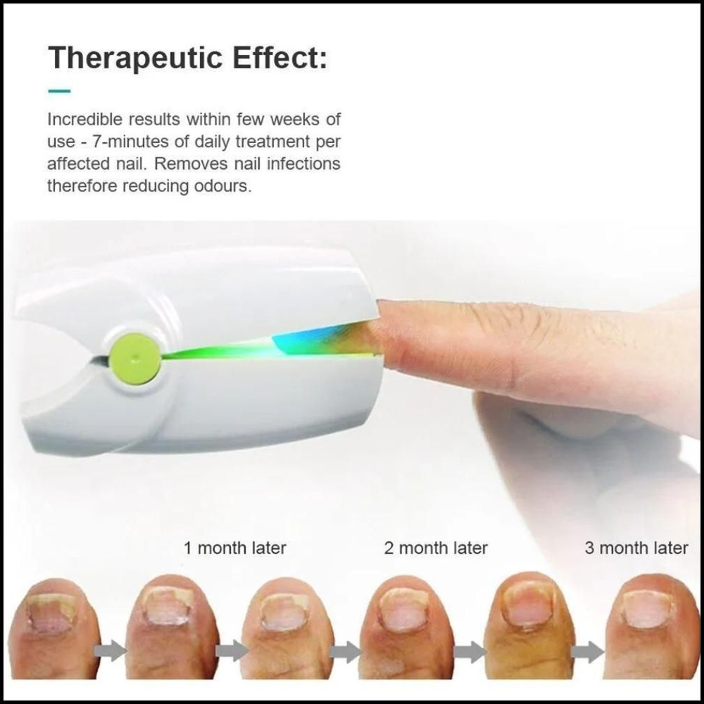 Прибор для лазерного лечения грибка ногтей относится к ...