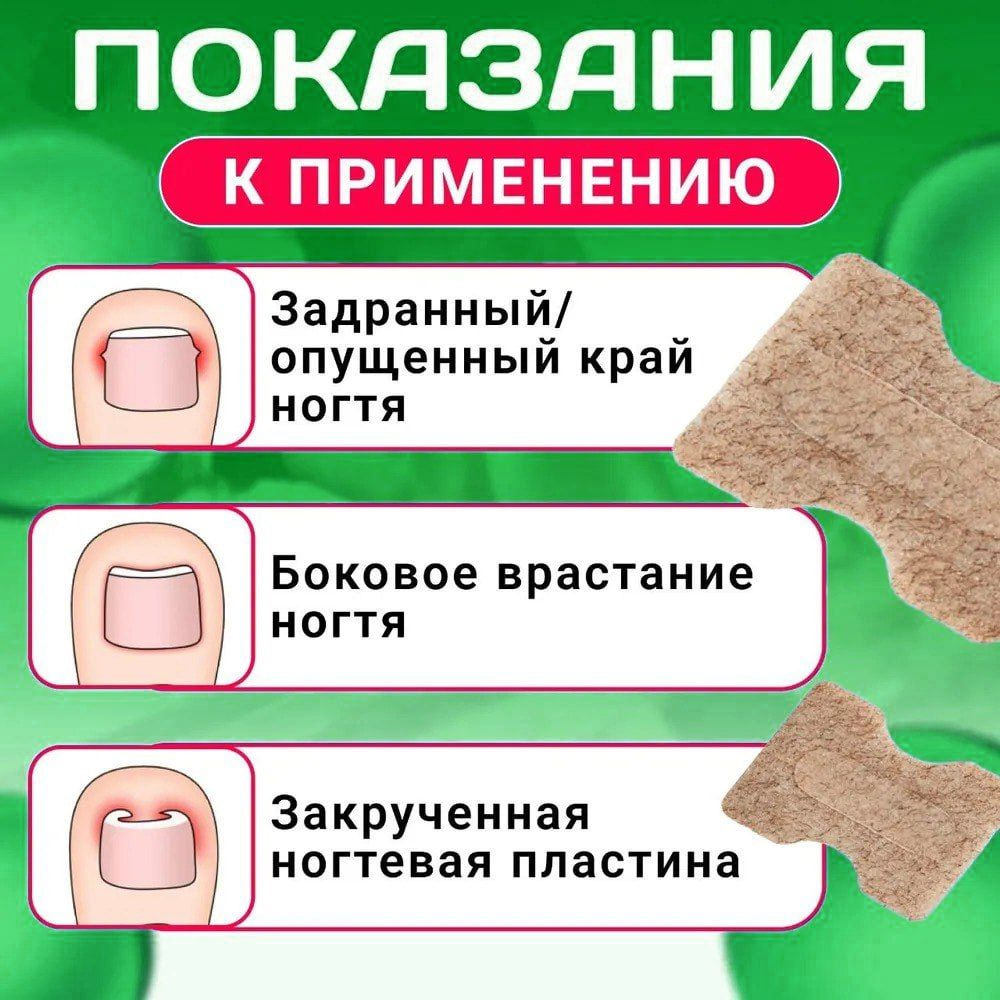 Пластырь корректор от вросшего ногтя, наклейка при врастании ногтевой ...
