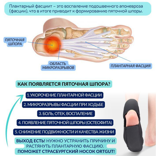 Артроз тазобедренного сустава (коксартроз) - симптомы и лечение