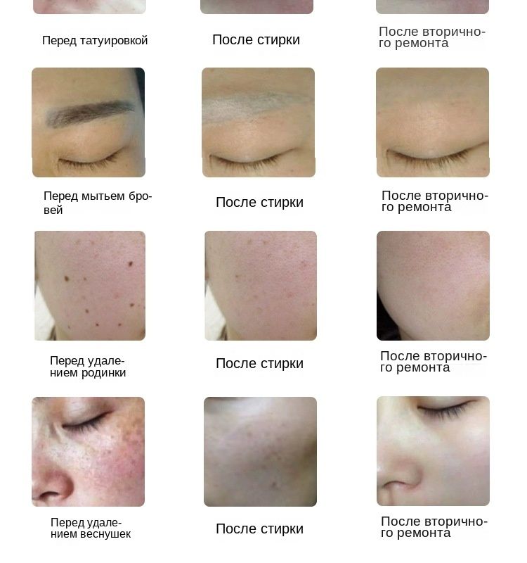 Лазерный терапевтический аппарат Инфракрасный направленный лазер для ...