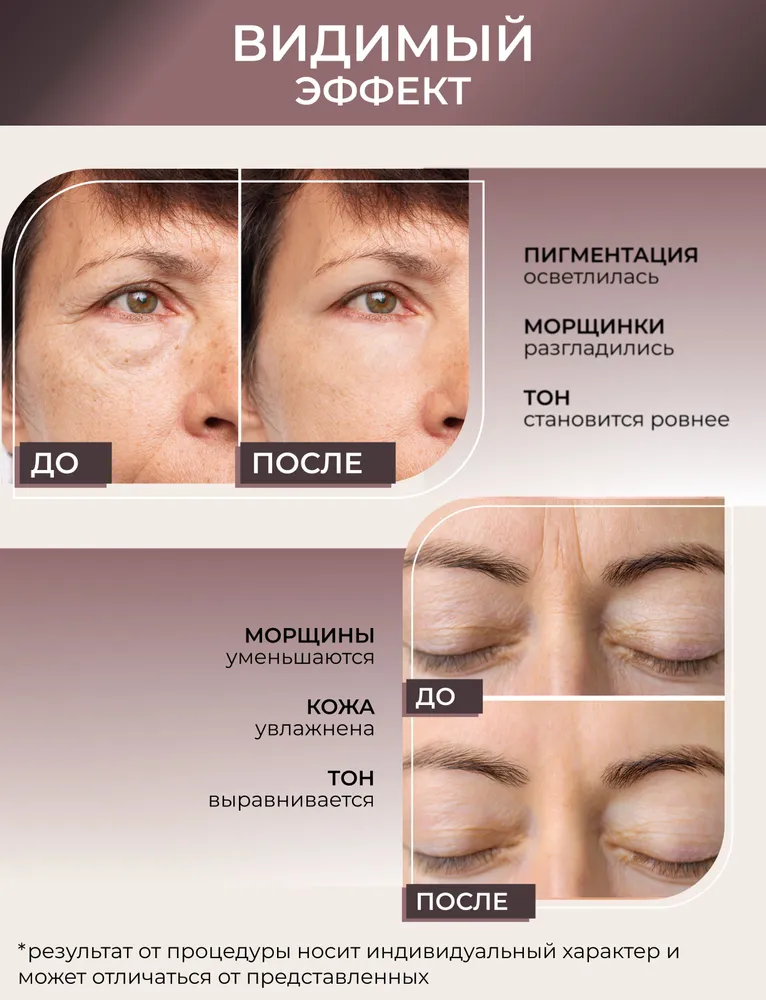 Дермапен аппарат для лица профессиональный Dr.pen ULTIMA A10 Микронилдлинг, Микроигольчатый лифтинг аппарат, вариант, фото 3