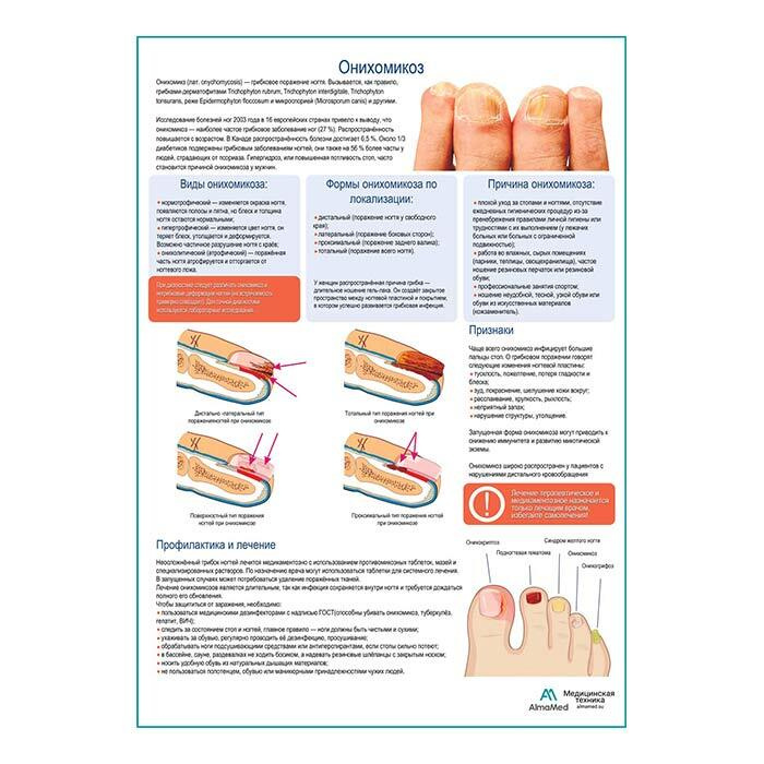 Онихомикоз медицинский плакат А1+, глянцевый холст от 200г/м2  #1