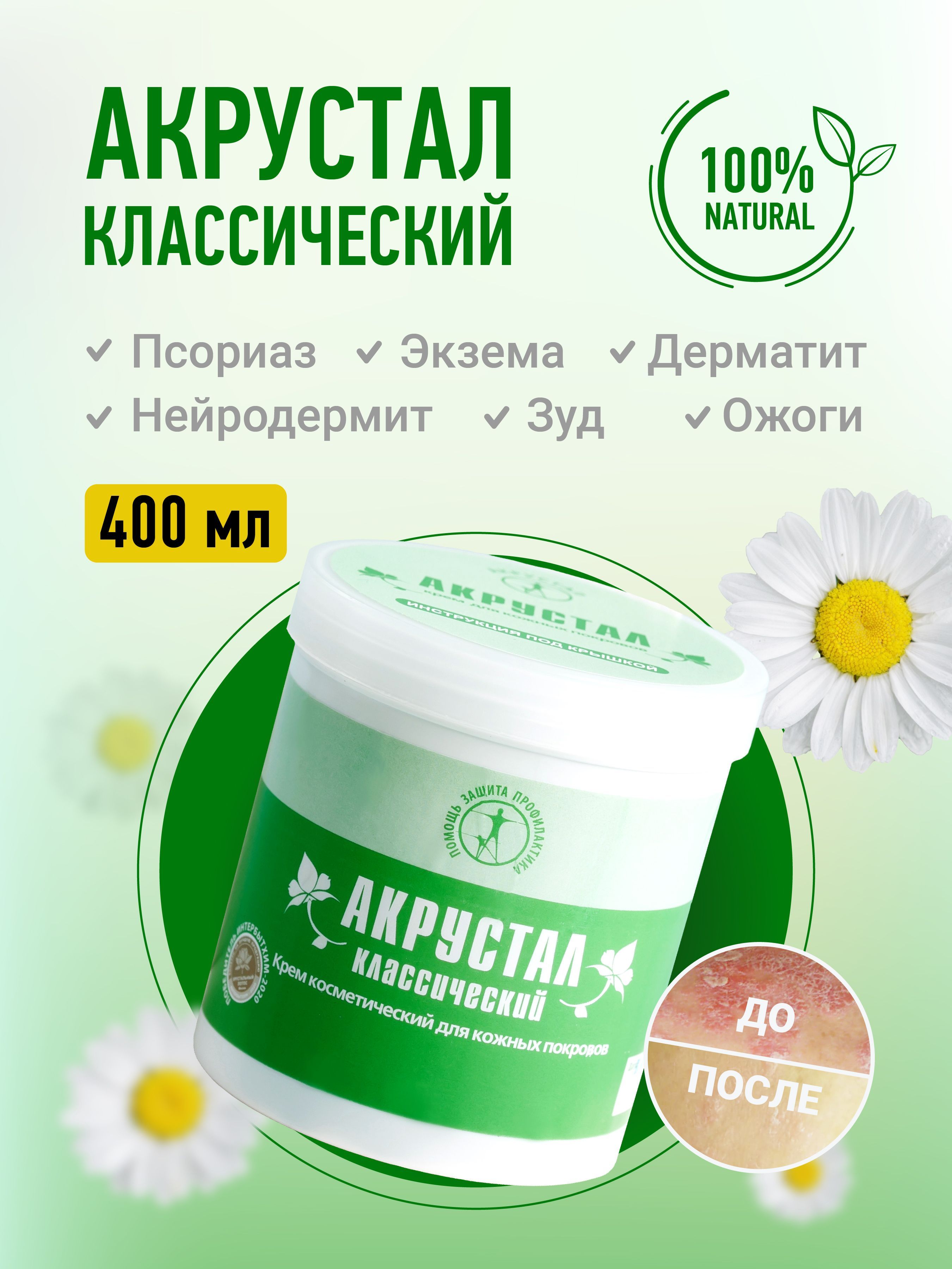 Акрустал Мазь От Псориаза Отзывы Цена